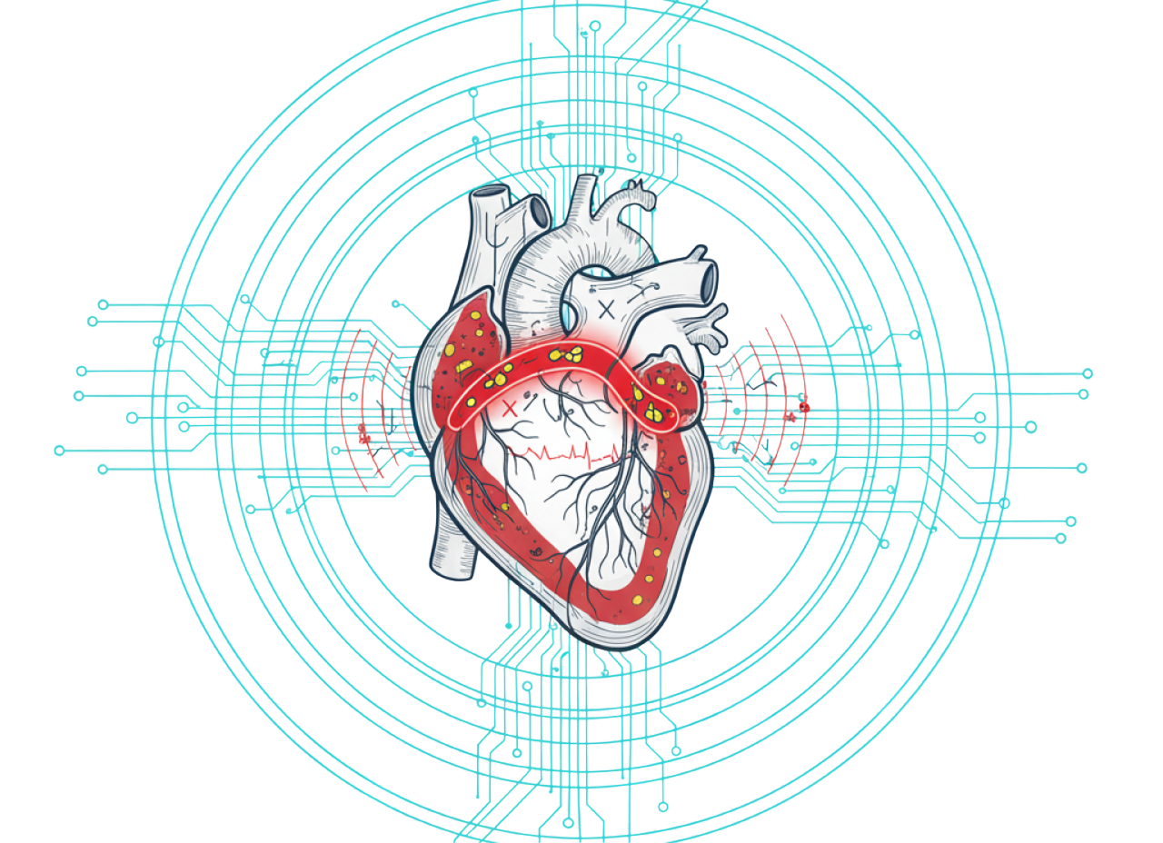 Acute Coronary Syndrome (ACS) 