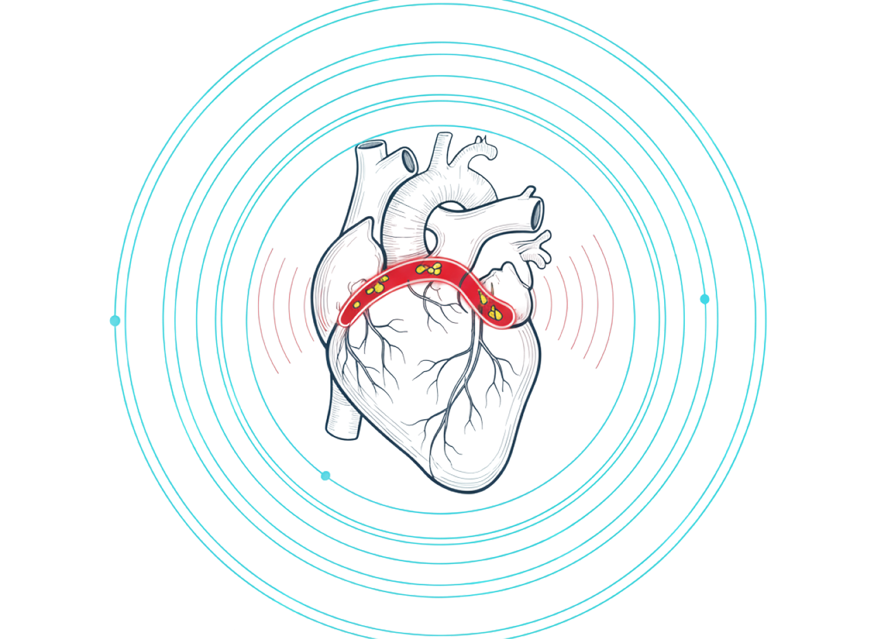 Coronary Artery Disease (CAD) 