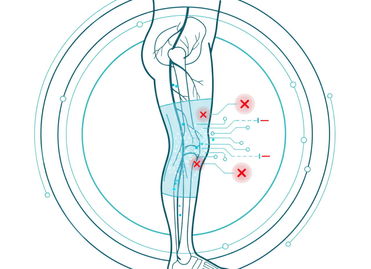 Deep Vein Thrombosis Prevention 