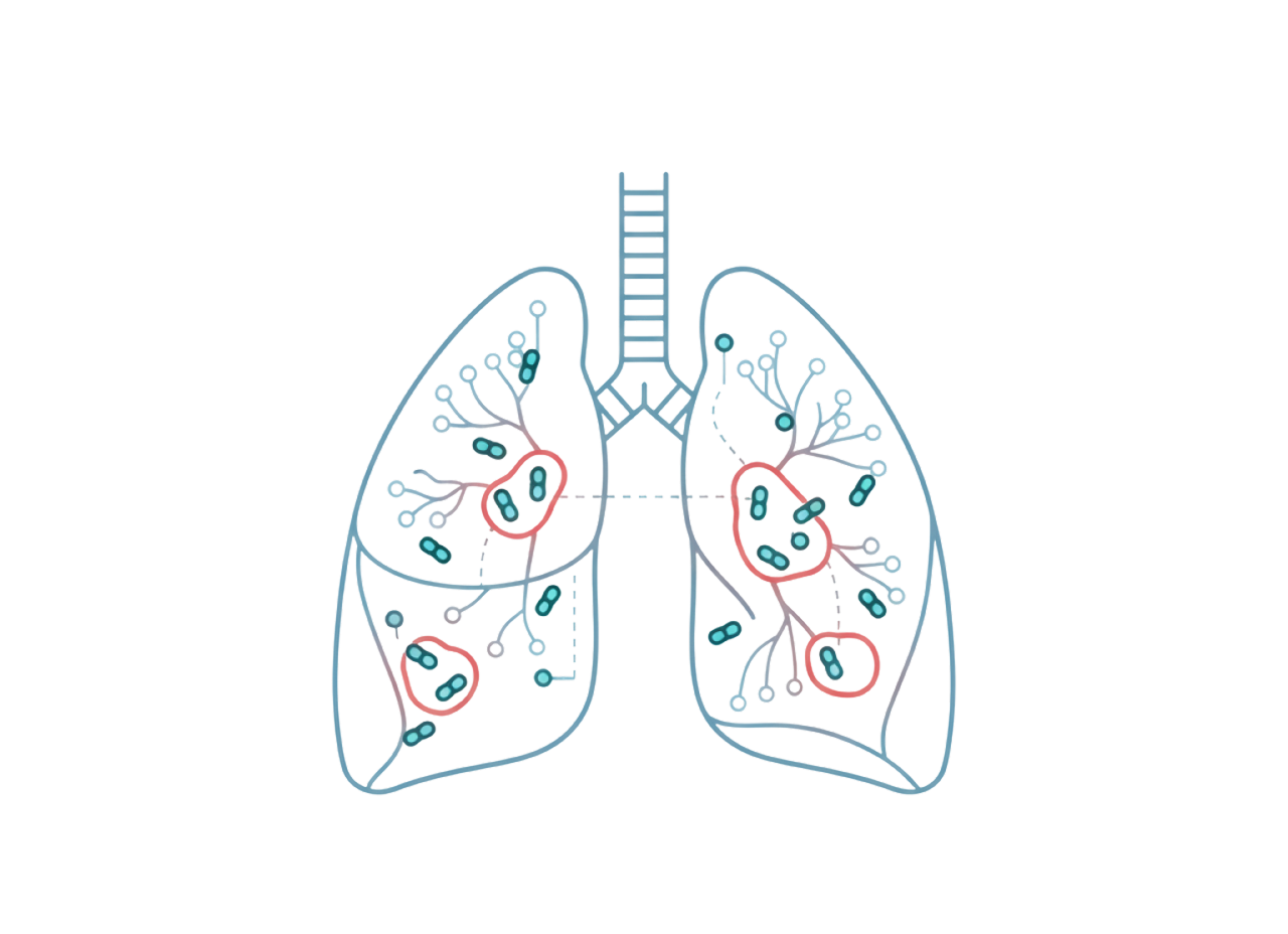 Mycobacterium Avium Complex (MAC) 