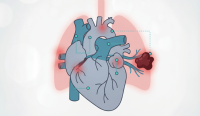 Pulmonary Embolism (PE)